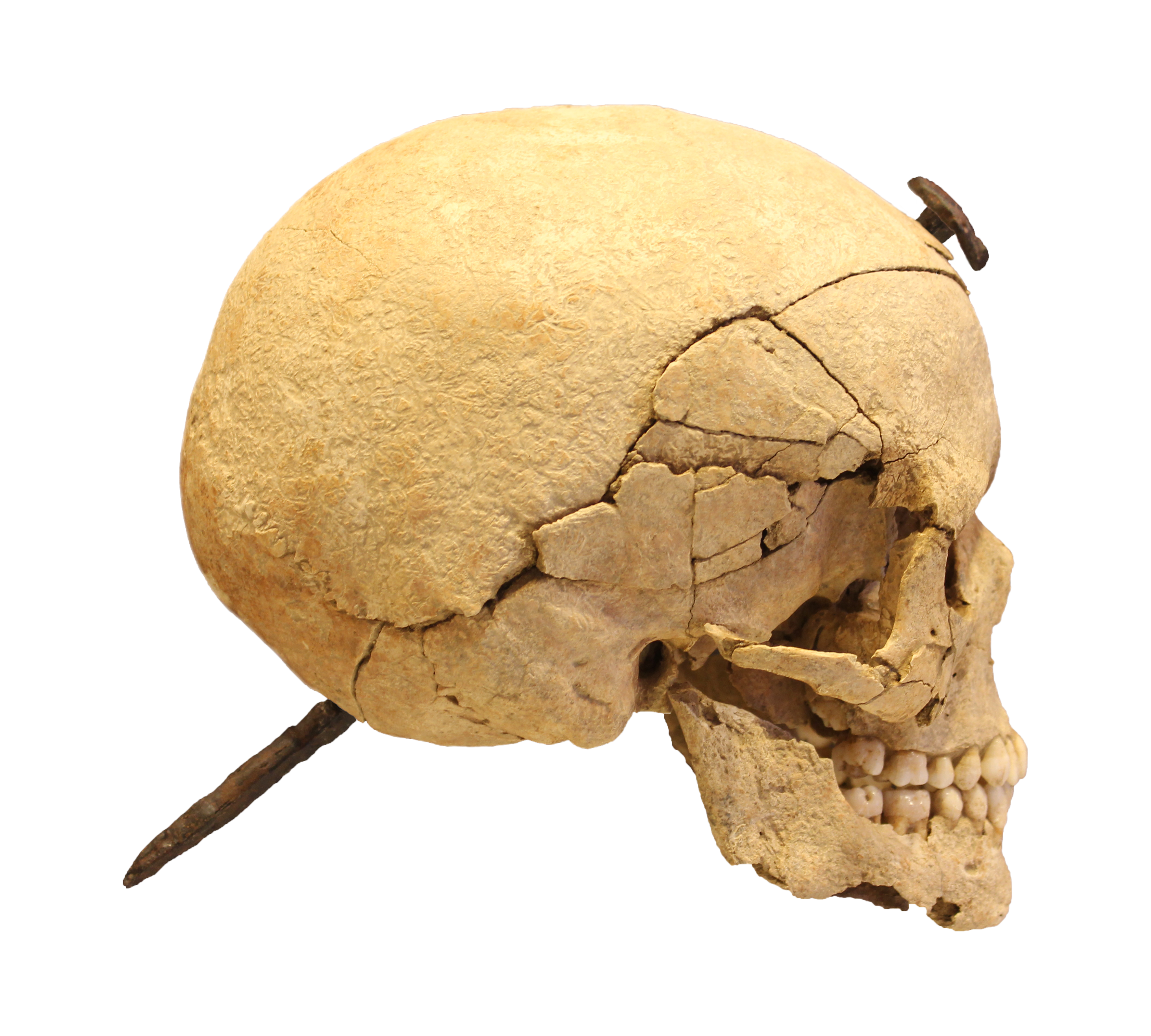 Crani travessat amb un clau de ferro.